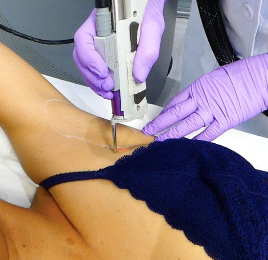 Comment se déroule une séance d'épilation laser à La Rochelle ? | Skin Clinic