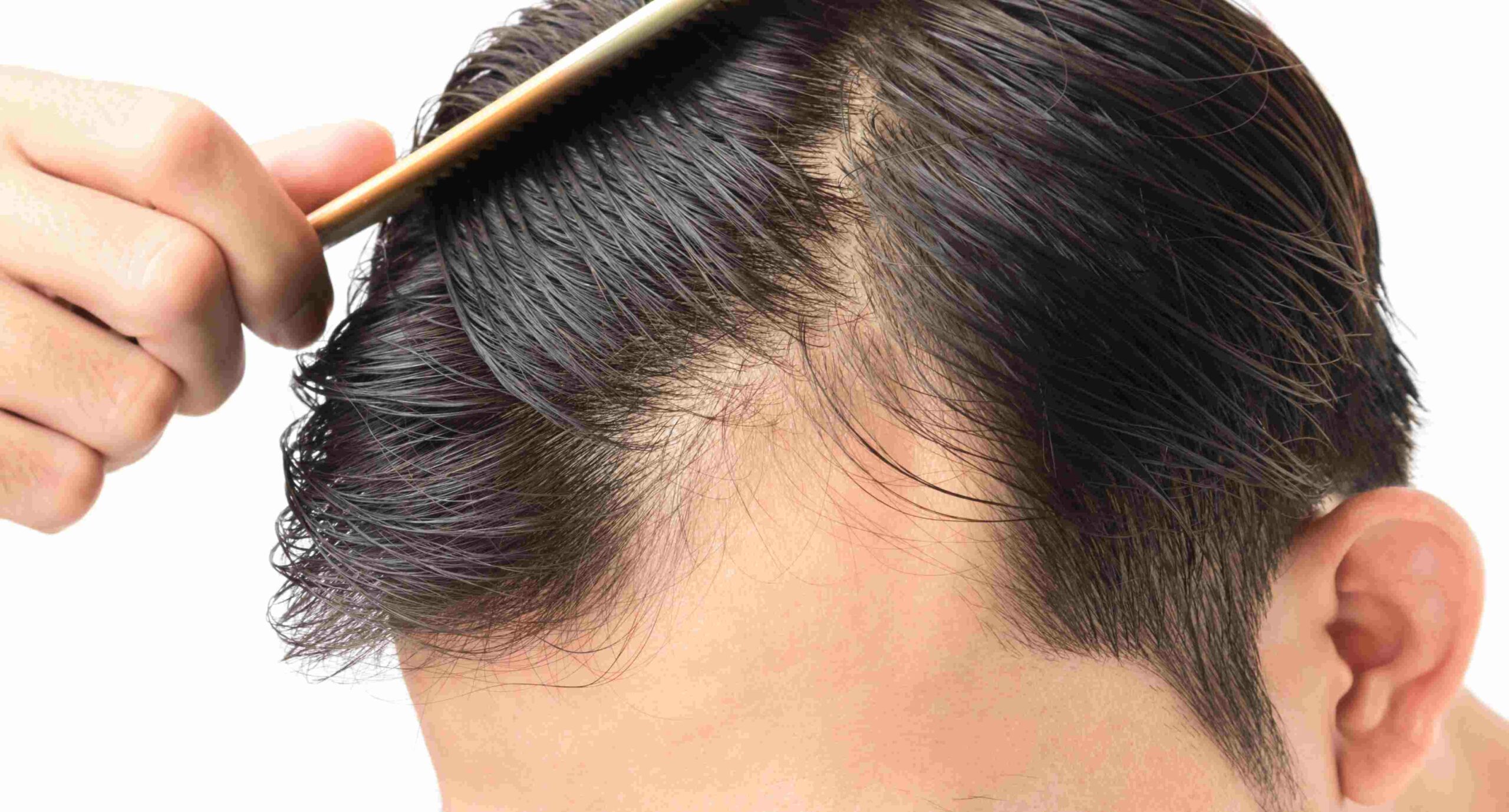 Quelle est la différence entre la calvitie et l'alopécie ? | Skin Clinic | Paris