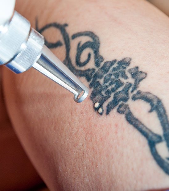 detatouage-precautions-centre-esthetique-laser-skinclinic-la-rochelle detatouage-precautions-centre-esthetique-laser-skinclinic-la-rochelle